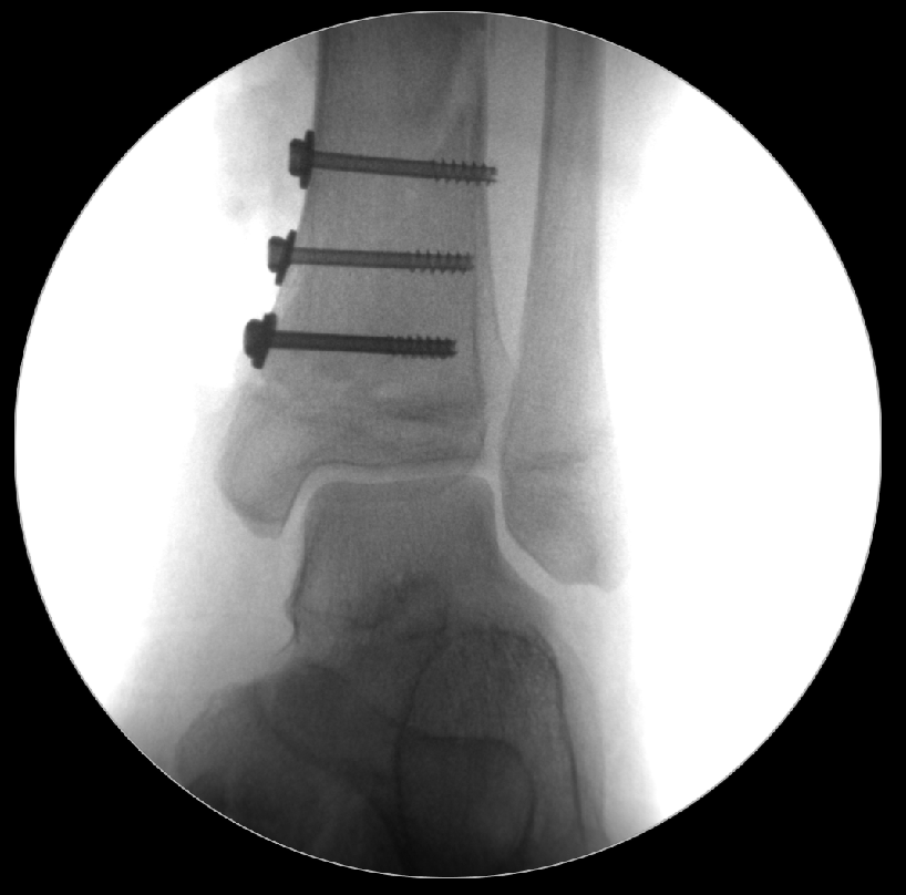 Salter Harris II Distal Tibia Fracture Minimally Invasive Screw Fixation